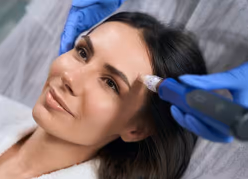 Photo of a woman getting a professional microneedling treatment