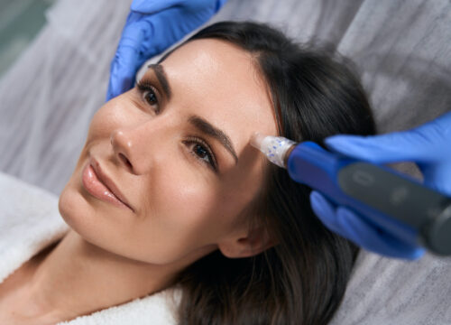 Photo of a woman getting a professional microneedling treatment