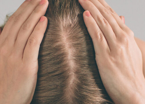 Photo of a woman experiencing hair loss