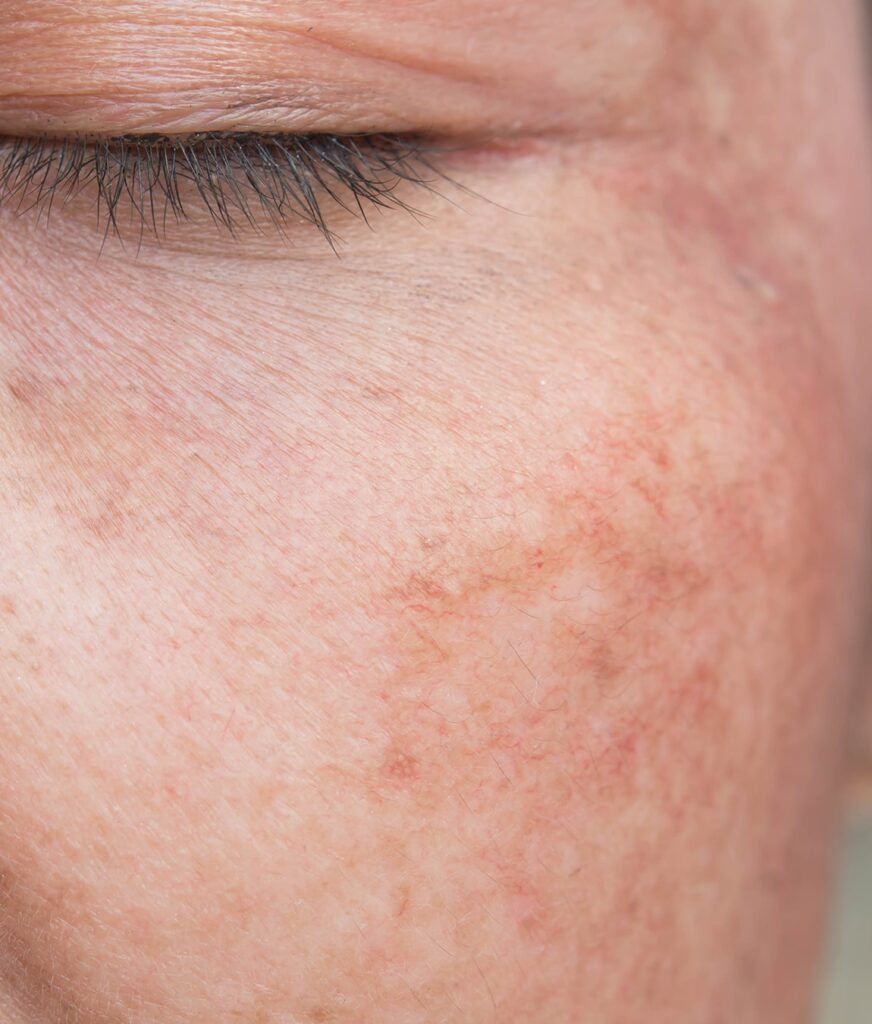 Photo of a hyperpigmentation on a woman's cheek
